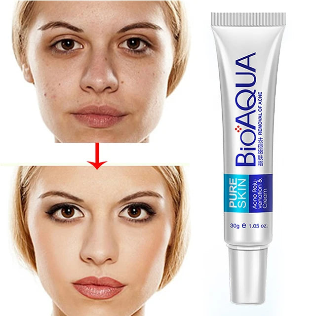 CREMA ANTIACNE ESPINILLA BIOAQUA